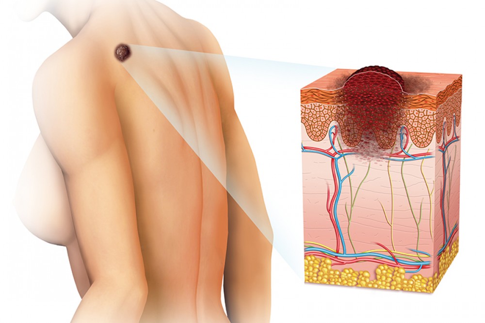 Cancerul de piele – semnele celor mai frecvente tipuri de cancere cutanate